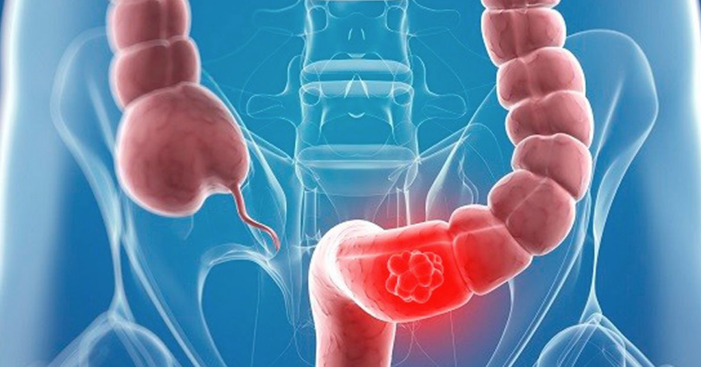 15 mil nuevos diagnósticos de cáncer de colon se registran anualmente en México