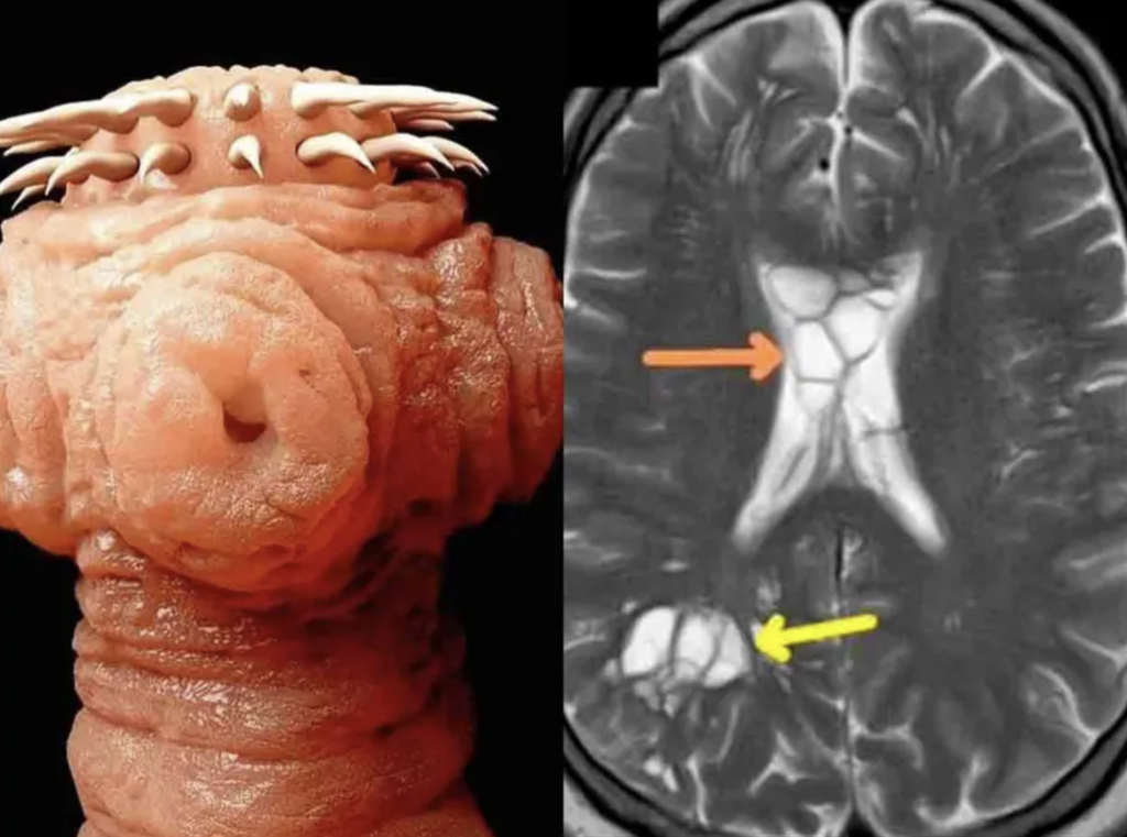Caso médico sorprendente: un hombre sufre de intensas migrañas por un gusano que vivía en su cerebro
