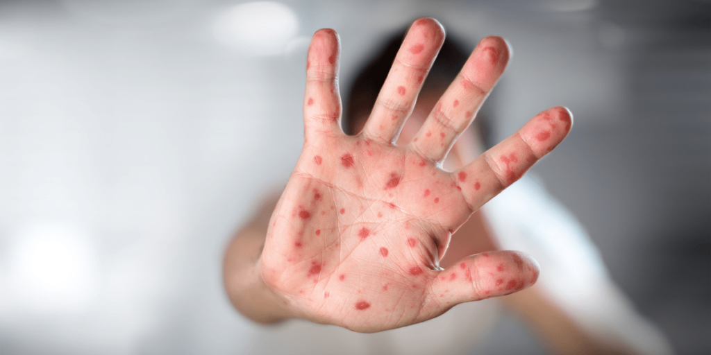 México reporta más de 200 casos y confirma 49 de viruela del mono