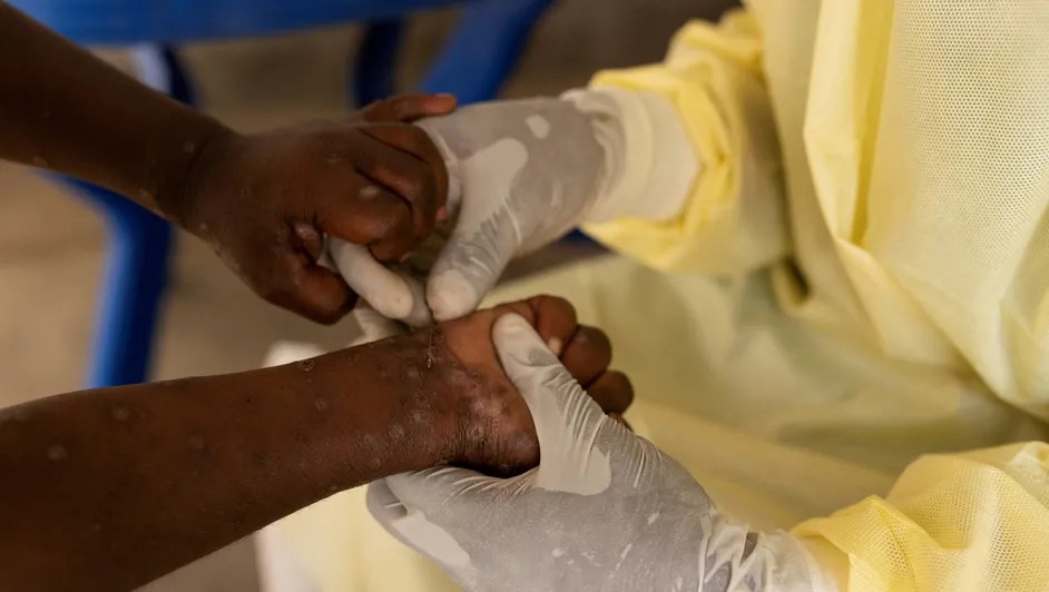 OMS mantiene la alerta por la epidemia de mpox ante aumento de casos en África