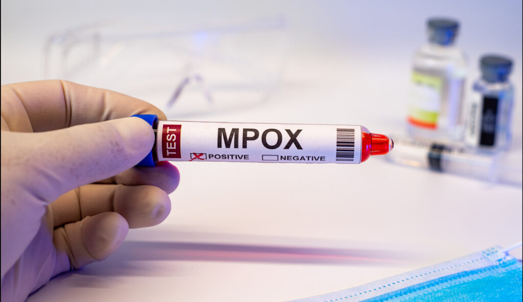 Se registran 43 casos de Mpox en Jalisco