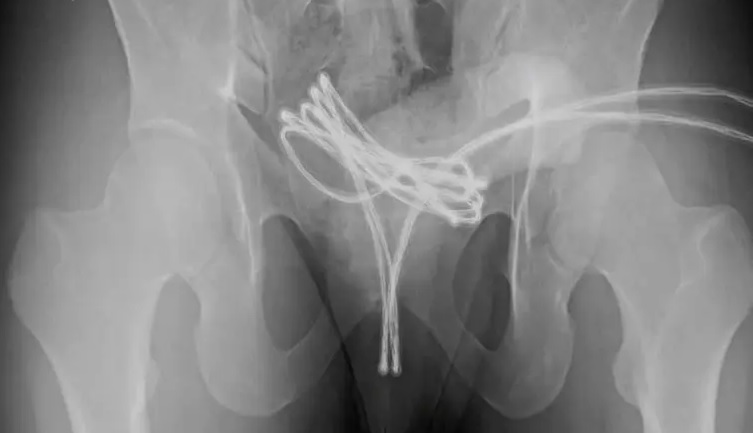 Joven termina en urgencias tras introducir cable USB en su uretra en peligrosa práctica sexual