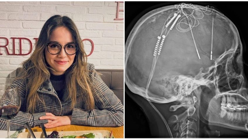 Mujer se somete a cirugía contra la depresión tras 17 años de padecerla