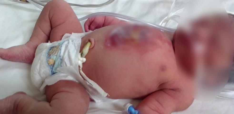 Bebé sufre quemaduras graves tras caerle olla de arroz, pero la factura médica casi destruye a su familia