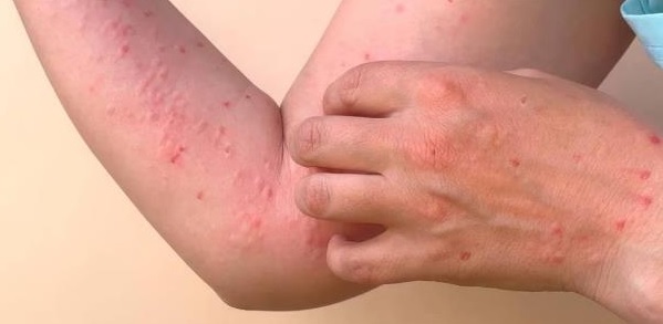 Alarmante brote de chikungunya en el sur de China