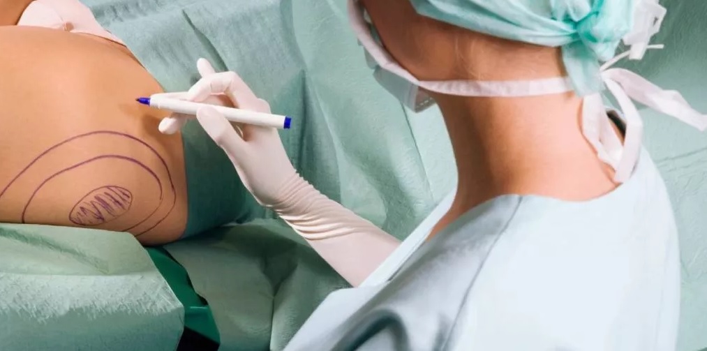 Pagó la liposucción de su esposa con un préstamo y ella lo dejó por otro