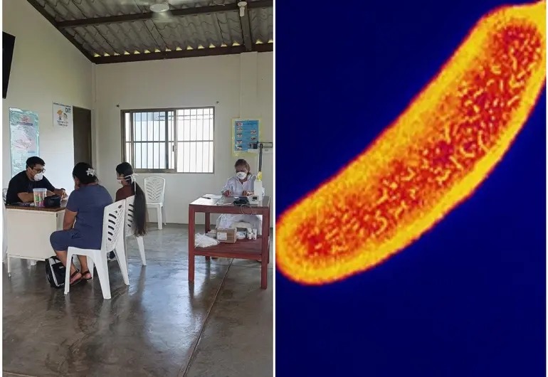 Alertan por posible brote de cólera en Veracruz; más de 100 personas presentan síntomas