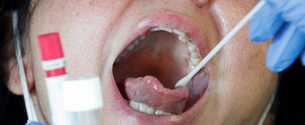 Nuevo test detecta tuberculosis en minutos con un simple hisopo en la lengua