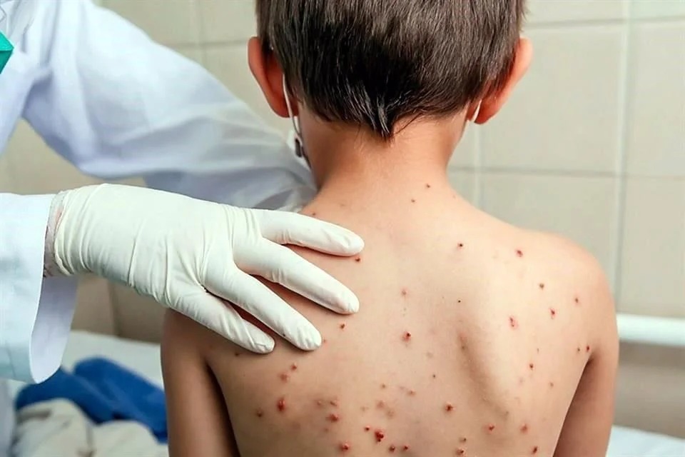 México logra contener brotes de sarampión, asegura Secretaría de Salud