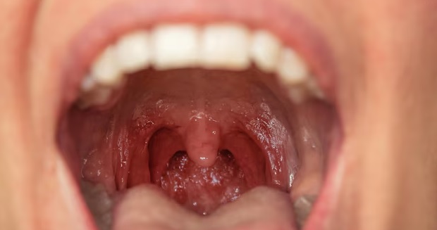 Confió en ChatGPT para un dolor de garganta ahora enfrenta cáncer terminal