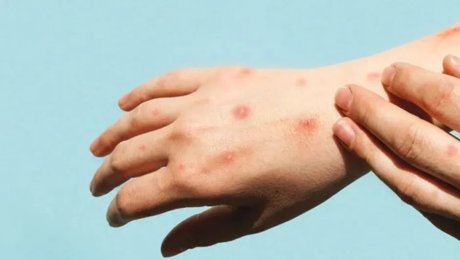 México enfrenta aumento alarmante de Mpox y VIH en 2025
