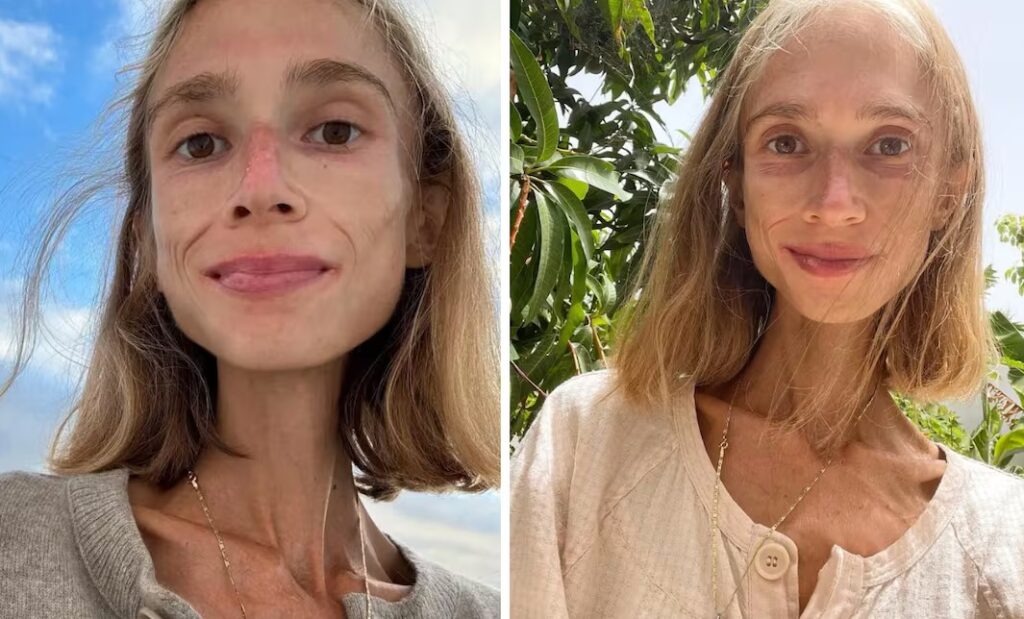 El Impactante Caso de Karolina Krzyzak: La Tragedia de las Dietas Extremas