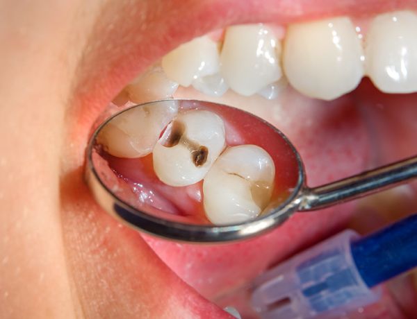 Caries generan un mayor riesgo de derrame cerebral