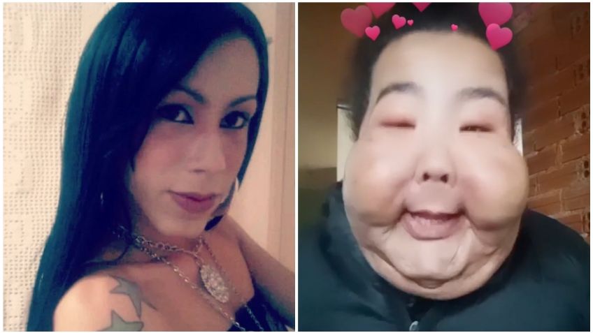 Influencer quedó «irreconocible» tras recibir inyecciones de aceite en una clínica ilegal