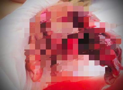 Niño de 6 años se amputa tres dedos con palomita, manipulaba pirotecnia
