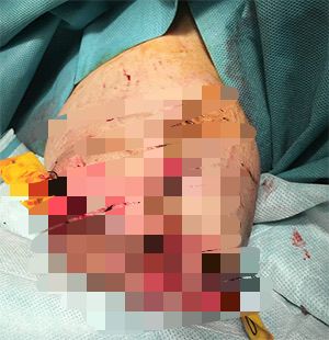 Joven de 15 años sin mano y niño de 6 sin dedos, conteo tras uso de pirotecnia, aparte incendios.