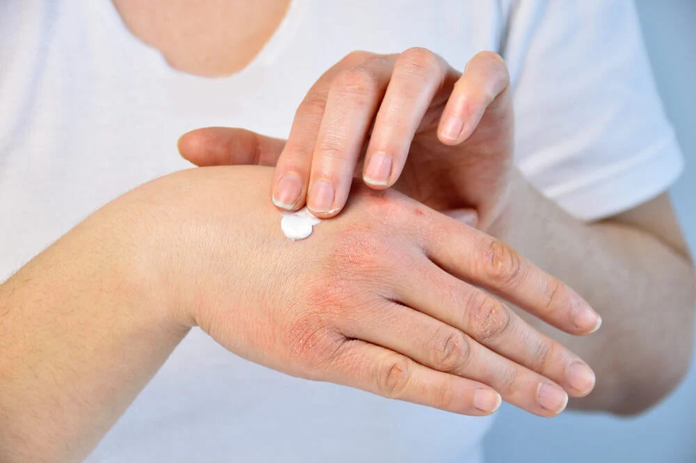 ¿Manos secas y cuarteadas? Protege la piel del frío
