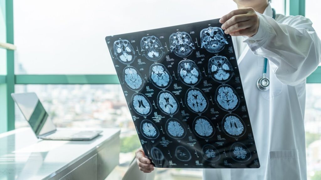 Proteína del cáncer podría ofrecer nuevas esperanzas contra el Alzheimer