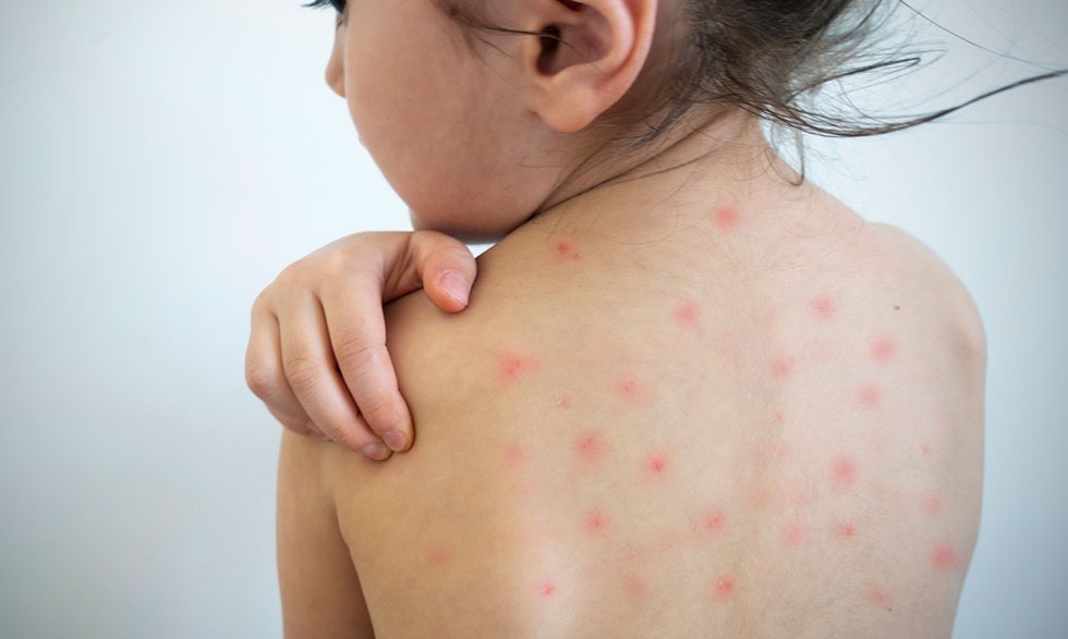OPS emite alerta epidemiológica por brote de sarampión en América
