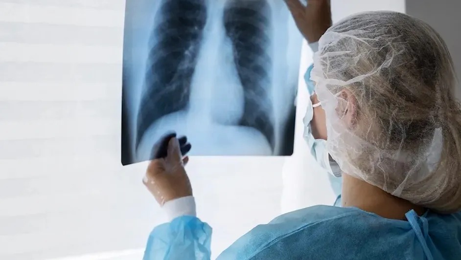 México enfrenta aumento de tuberculosis y brote activo de sarampión en 2026