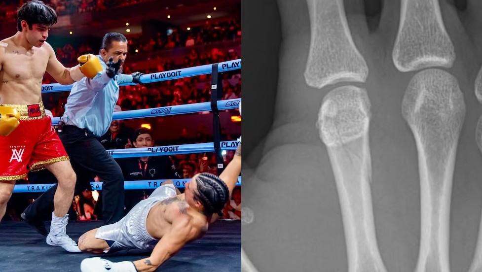 Mario Bautista termina fracturado tras su fugaz pelea contra Aaron Mercury
