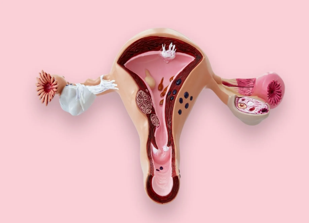 Miomas uterinos: el padecimiento que afecta a 4 de cada 10 mujeres
