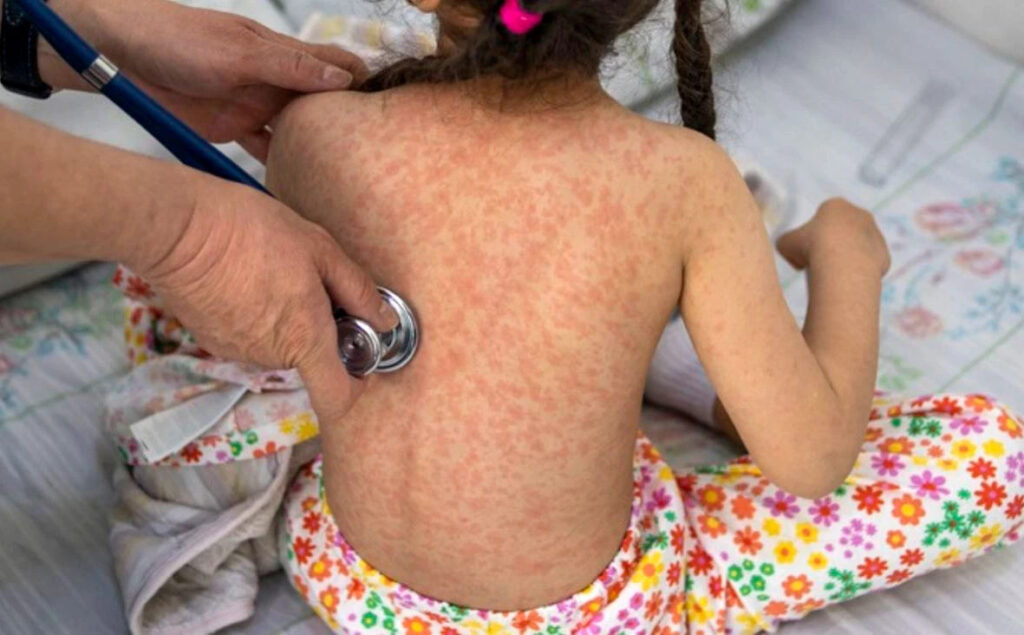 Sarampión en México suma 38 nuevos casos y refuerzan vigilancia sanitaria