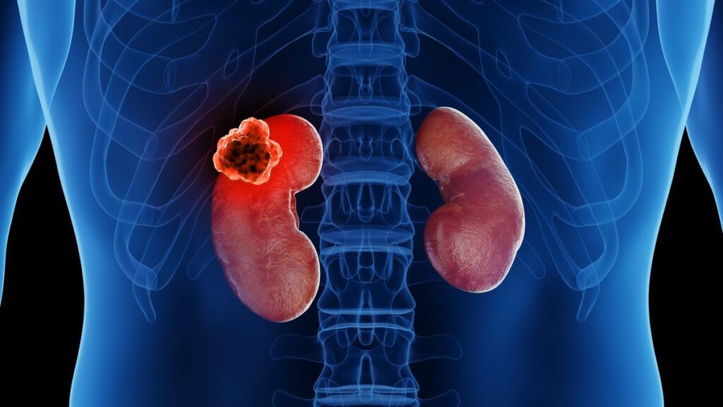 Más de 400 mil casos de cáncer de riñón se diagnostican cada año en el mundo